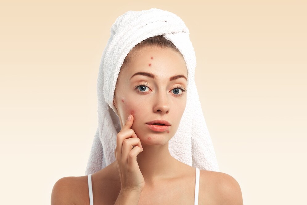 What-to-Do-After-Removing-the-Pimple-Patch The Bath and Care