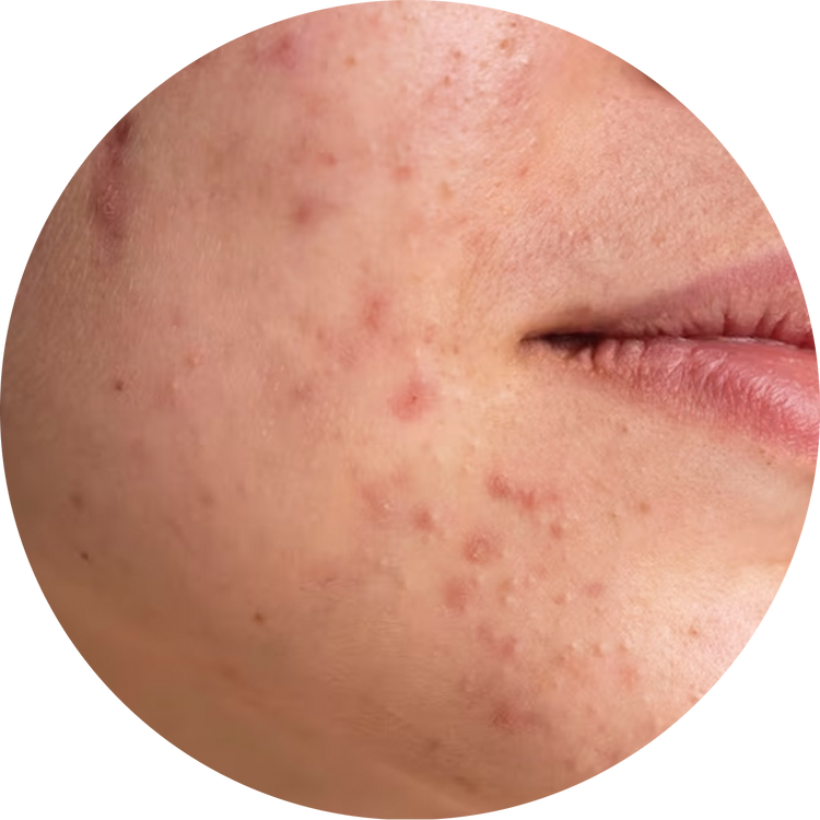 Acne-Pore-Skin The Bath and Care