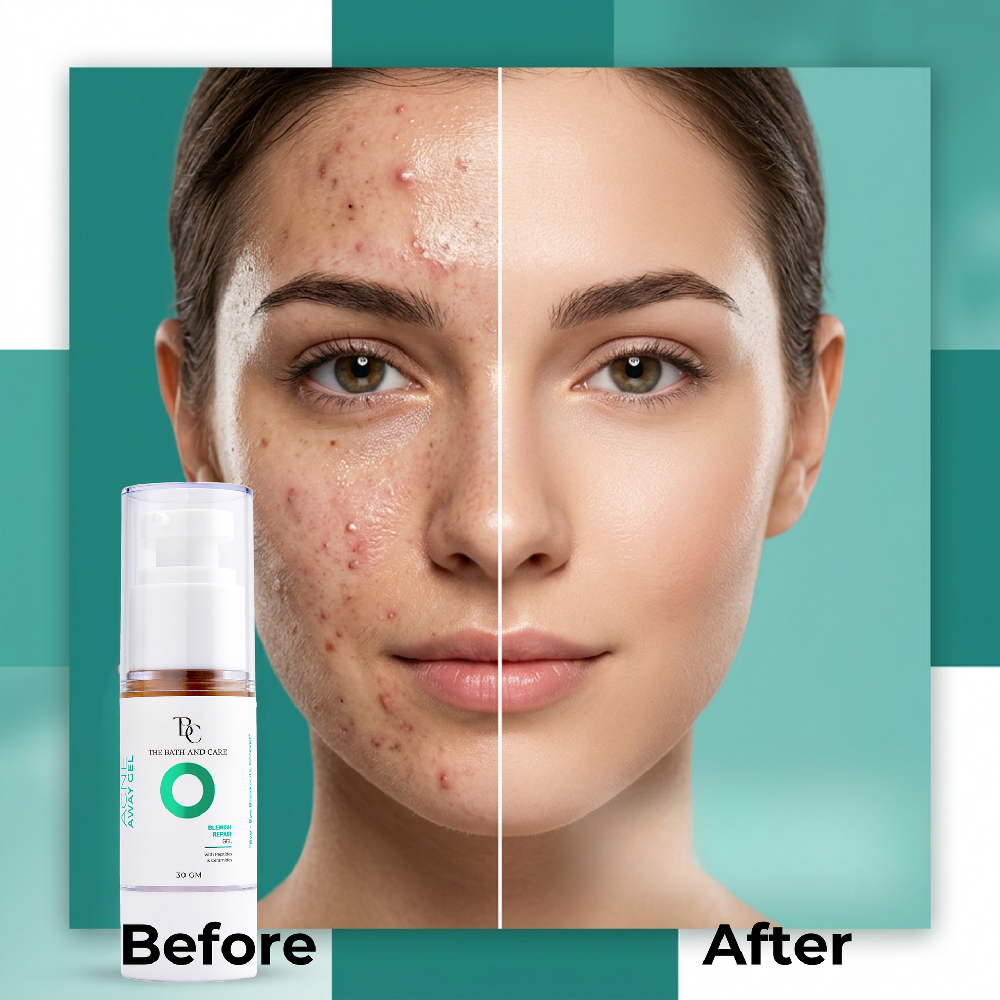 Acne Away Gel – Anti Acne Face Gel with Aloe Vera, Tea Tree, Clove Oil, Peptides & Ceramides The Bath and Care