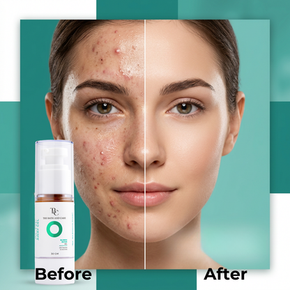 Acne Away Gel – Anti Acne Face Gel with Aloe Vera, Tea Tree, Clove Oil, Peptides & Ceramides The Bath and Care