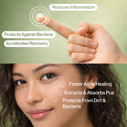 Clear Cue Acne Patches â€“ Overnight Pimple Solution with Hydrocolloid Technology The Bath and Care