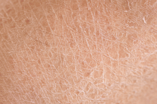 Dry Skin