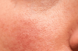 Sensitive Skin