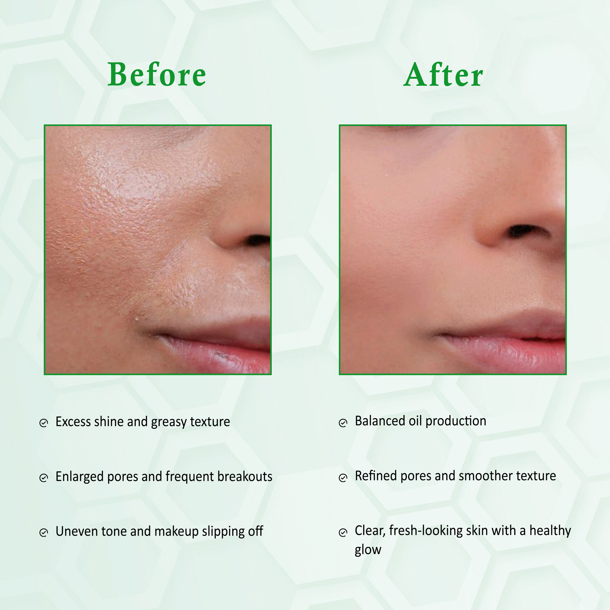 Pore Minimizing & Oil Control Face Serum for Anti Acne The Bath and Care