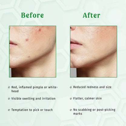 Green Clay Mask - Anti Acne Face Mask The Bath and Care