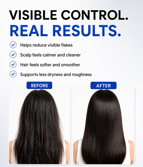 Kombuchka Rice Water Anti-Dandruff Conditioner – Defend & Control for Flaky, Oily Scalp, Helps Reduce Dandruff, Scalp Flakes & Excess Oil
